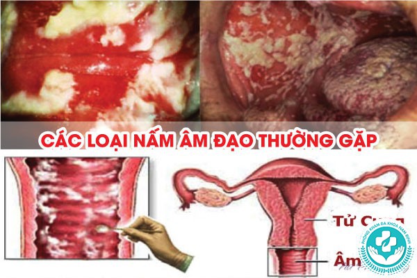 các loại nấm âm đạo