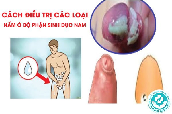 các loại nấm ở bộ phận sinh dục nam