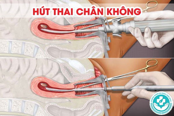 các phương pháp phá thai theo tháng