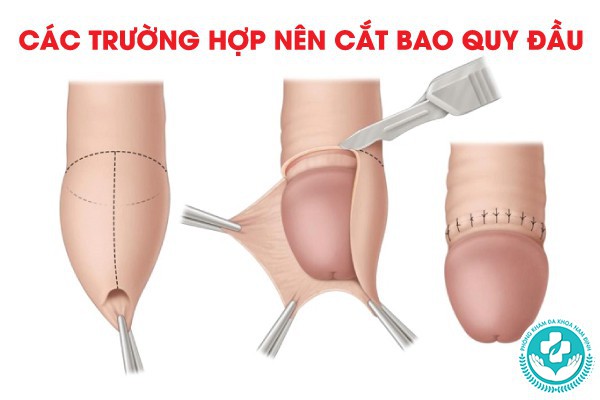 các trường hợp nên cắt bao quy đầu