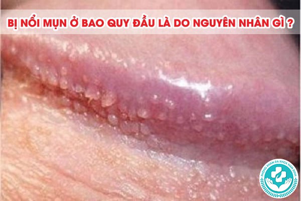 cách chữa nổi mụn ở bao quy đầu tại nhà