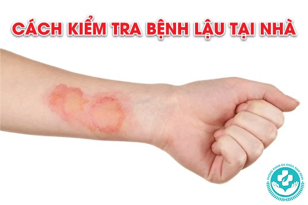 cách kiểm tra bệnh lậu