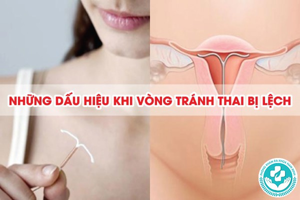 cách kiểm tra vòng tránh thai tại nhà