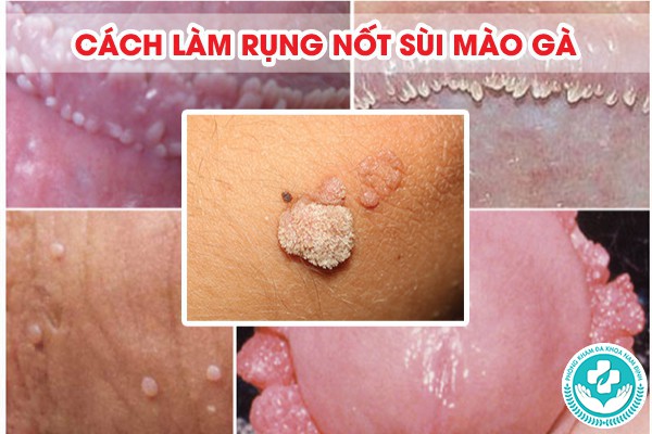 cách làm rụng nốt sùi mào gà