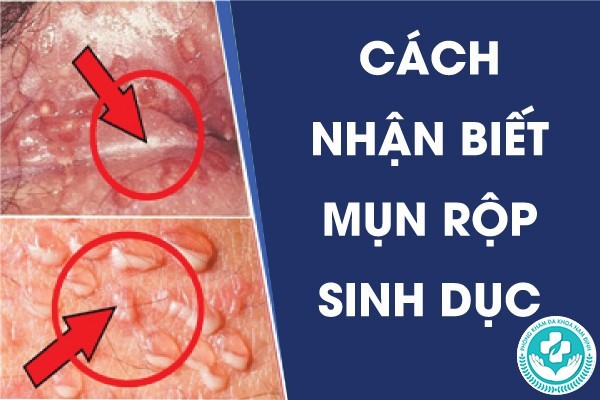 cách nhận biết mụn rộp sinh dục