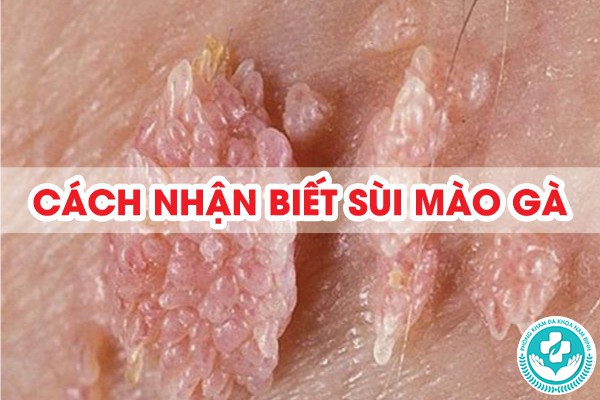 cách nhận biết sùi mào gà