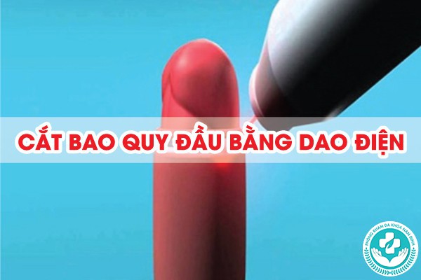 cắt bao quy đầu bằng dao điện