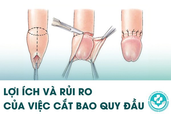 cắt bao quy đầu bằng dao điện