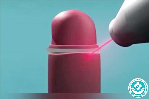 cắt bao quy đầu bằng laser