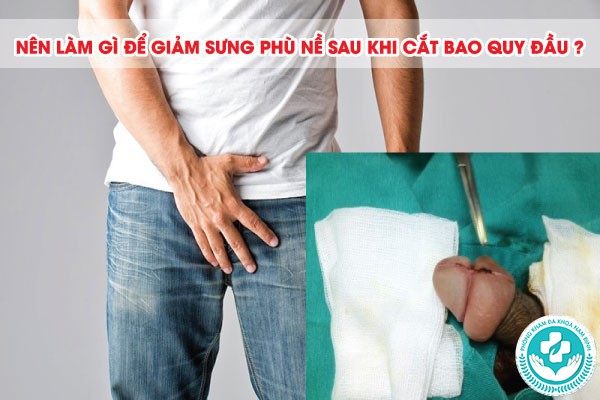 Cắt bao quy đầu bao lâu hết sưng phù nề Cắt bao quy đầu bao lâu hết sưng phù nề