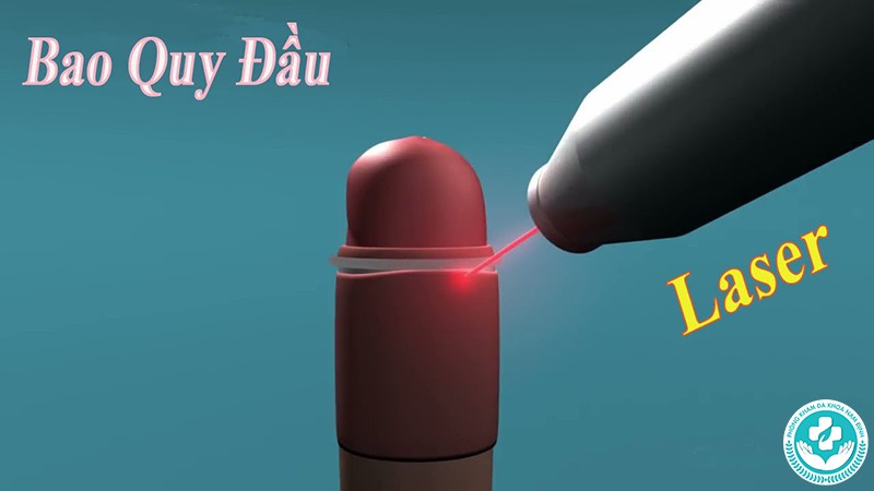 Cắt bao quy đầu tại Hòa Bình Cắt bao quy đầu tại Hòa Bình