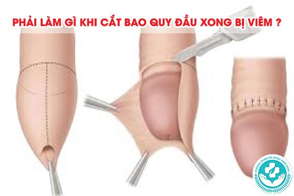 cắt bao quy đầu xong bị viêm