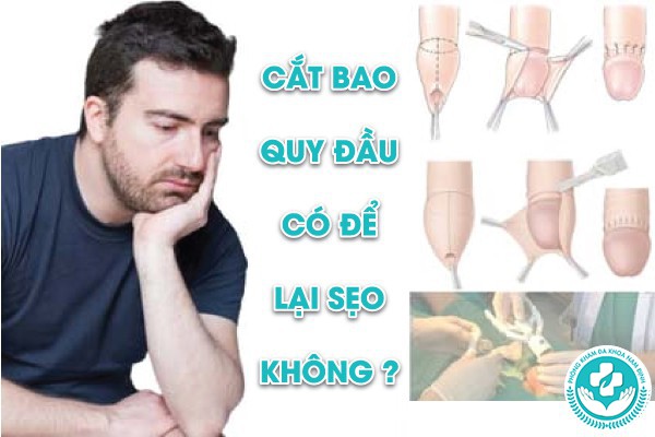 cắt bao quy đầu xong có đi lại được không