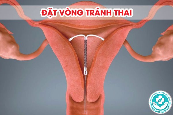 cấy que hay đặt vòng tốt hơn
