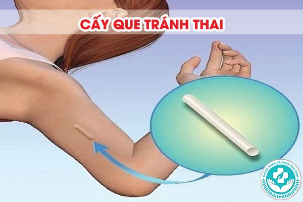 cấy que hay đặt vòng tốt hơn