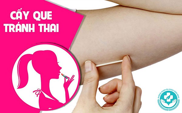 cấy que tránh thai ở ninh bình