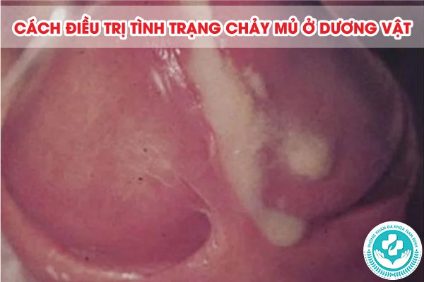 chảy mủ ở dương vật