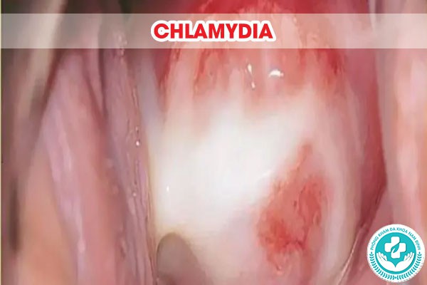 chlamydia chữa bao lâu thì khỏi chlamydia chữa bao lâu thì khỏi