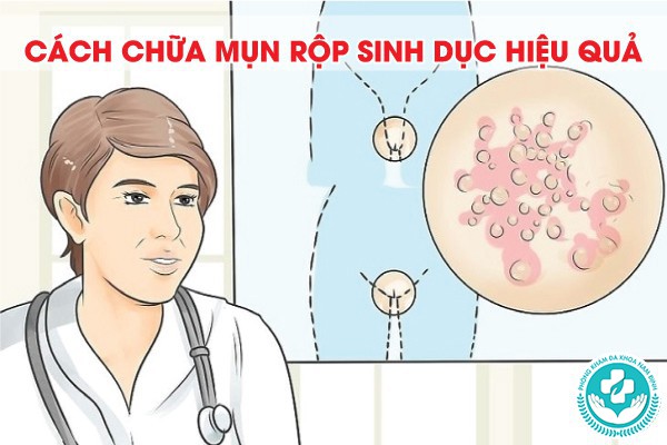 chữa mụn rộp sinh dục bằng thuốc nam