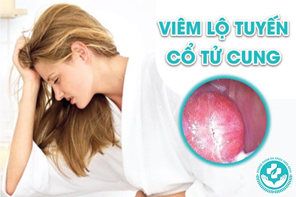 chữa viêm lộ tuyến cổ tử cung ở đâu