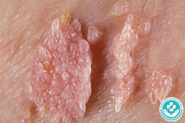 chuỗi hạt ngọc dương vật bị rát chuỗi hạt ngọc dương vật bị rát