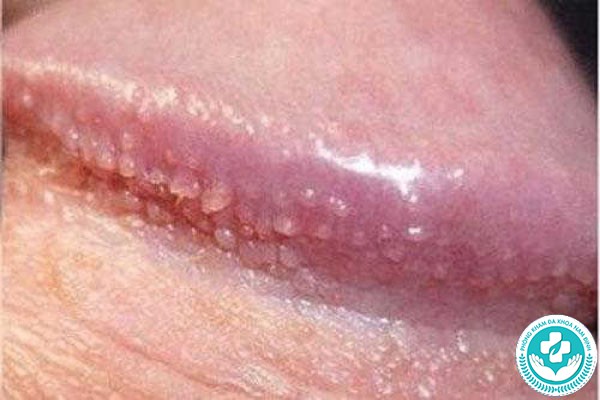 chuỗi hạt ngọc dương vật và sùi mào gà