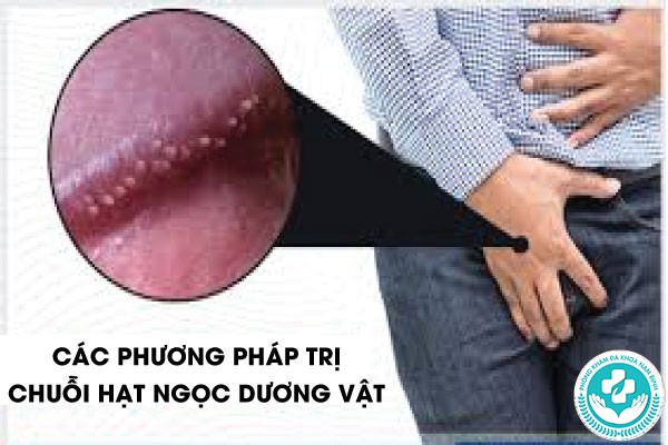 Chuỗi hạt ngọc ở nam
