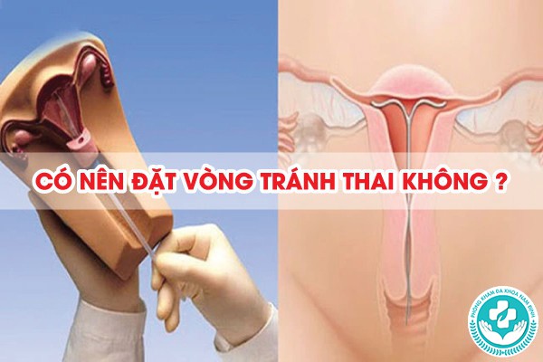 có nên đặt vòng tránh thai