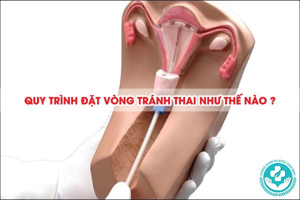 đặt vòng tránh thai