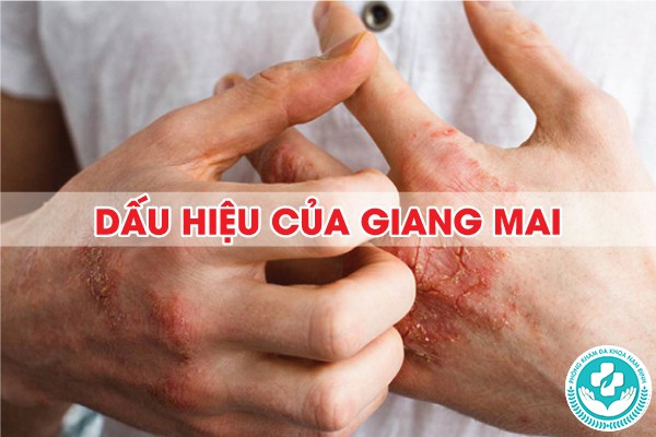 dấu hiệu của giang mai