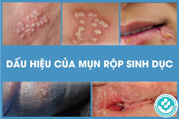 dấu hiệu của mụn rộp sinh dục