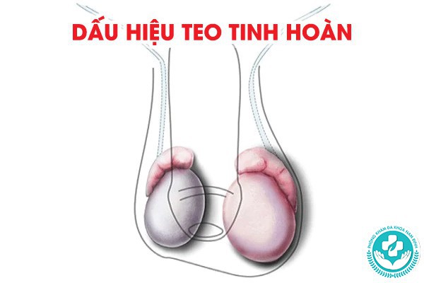 dấu hiệu teo tinh hoàn