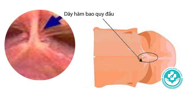 dây hãm dương vật bị rách dây hãm dương vật bị rách