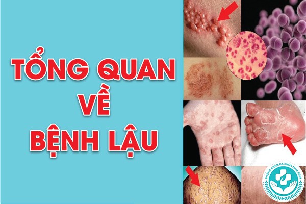 Địa chỉ chữa bệnh lậu tại Lý Nhân