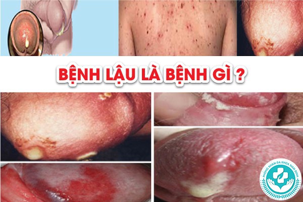 Địa chỉ chữa bệnh lậu tại Nam Trực