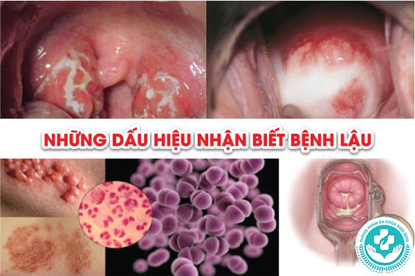 Địa chỉ chữa bệnh lậu tại Ý Yên