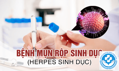 địa chỉ chữa mụn rộp sinh dục tại ninh bình địa chỉ chữa mụn rộp sinh dục tại ninh bình