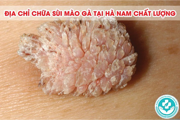 địa chỉ chữa sùi mào gà tại Hà Nam