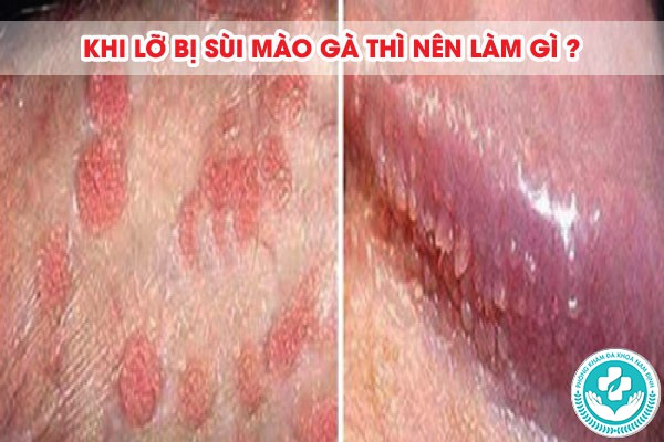 địa chỉ chữa sùi mào gà tại Hưng Yên