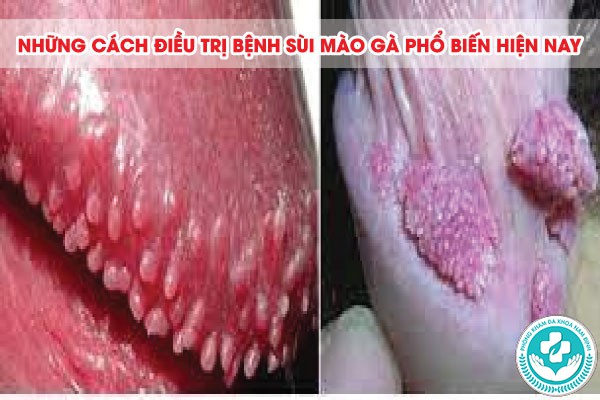 địa chỉ chữa sùi mào gà tại Ninh Bình