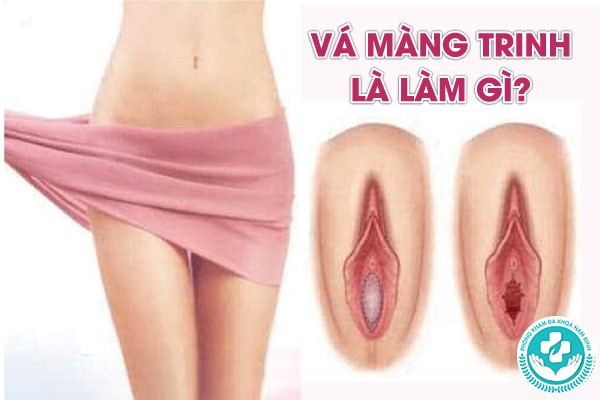 điều kiện để vá màng trinh