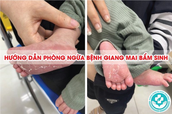 điều trị giang mai bẩm sinh