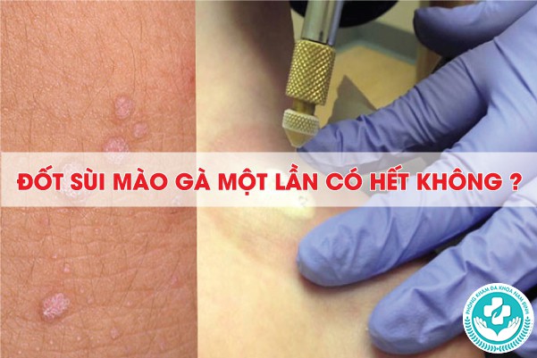 đốt sùi mào gà 1 lần có hết không