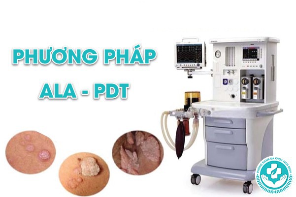 đốt sùi mào gà bằng ALA – PDT bao nhiêu tiền