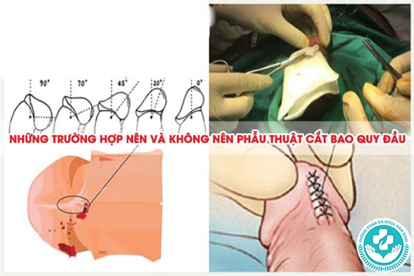 dương vật chưa cắt bao quy đầu