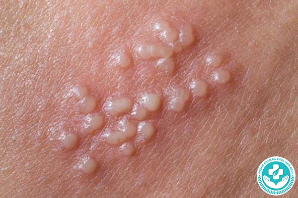 Dương vật nổi mụn