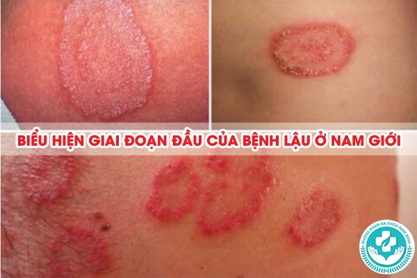 giai đoạn đầu của bệnh lậu