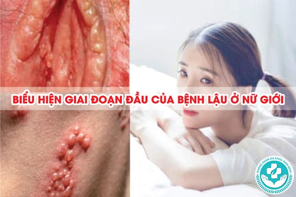 giai đoạn đầu của bệnh lậu