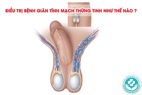 Giãn tĩnh mạch thừng tinh