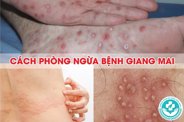 giang mai có chữa được không